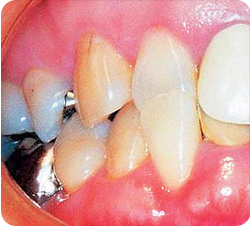 矯正歯科患者写真1