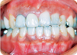 矯正歯科患者写真2