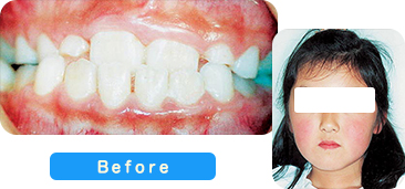 矯正歯科患者写真2