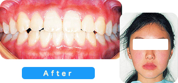 矯正歯科患者写真2