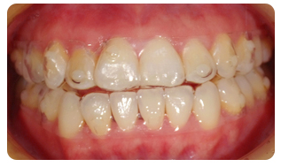 マウスピース写真1