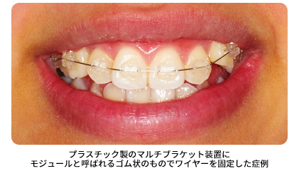 マウスピース写真3