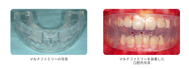 マウスピース写真4