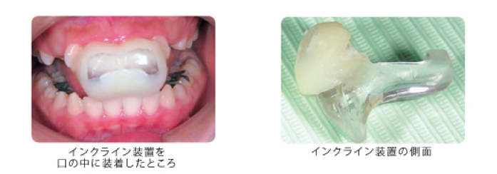 マウスピース写真6