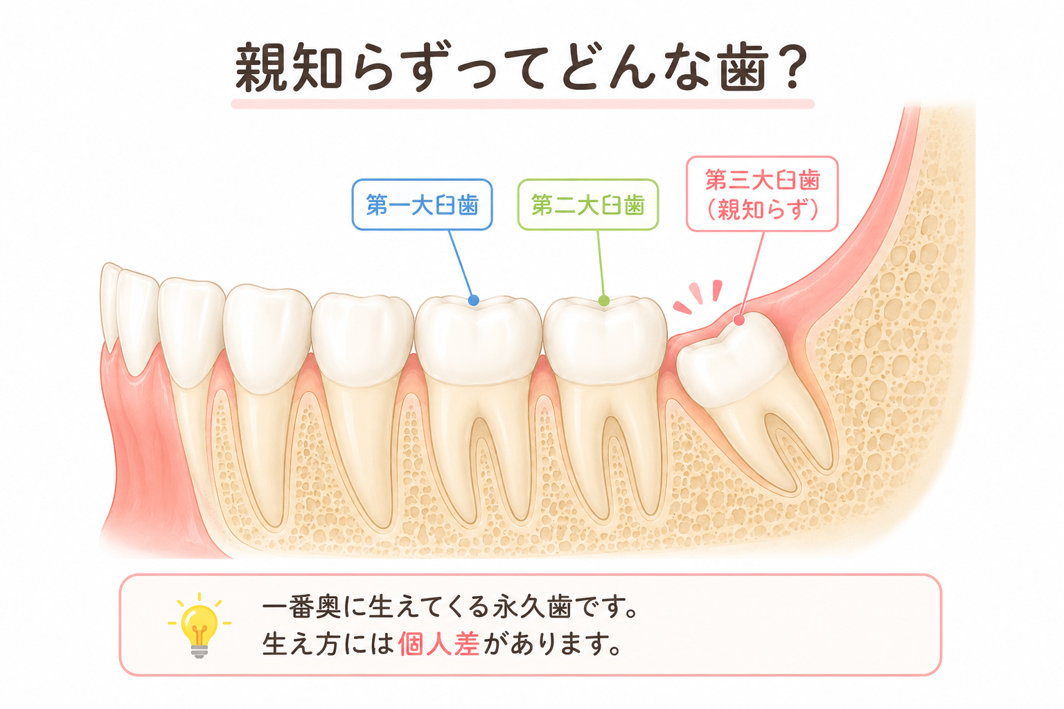 親知らずの生え方を説明するイラスト